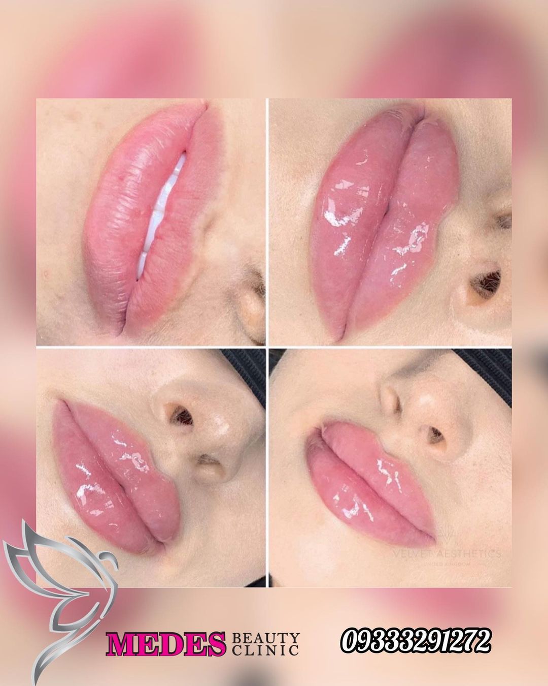 گالری تزریق ژل لب